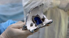 Встать на ноги в Балаково помогают операции на коленных и тазобедренных суставах