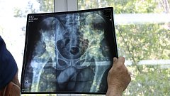 Встать на ноги в Балаково помогают операции на коленных и тазобедренных суставах